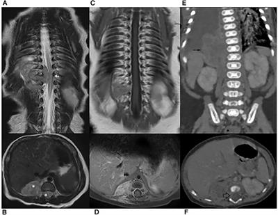 Abdominal rhabdoid tumor presenting with symptomatic spinal epidural compression in a newborn. A case report